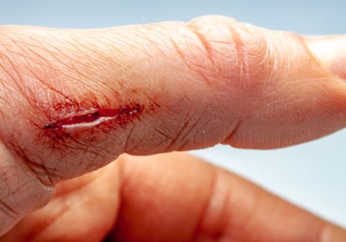 What Is Slough On A Wound? Identifying And Managing Wound Dehiscence