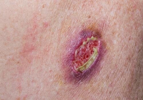 Wound Dehiscence: Causes, Treatment, and Prevention