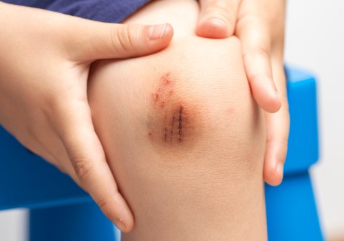 Key Wound Infection Symptoms to Watch For: A Guide to Avoiding Wound Dehiscence