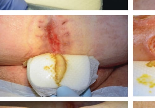 The Hidden Dangers of Wound Dehiscence: An Expert's Perspective