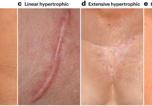 Healing Beyond the Surface: Hypertrophic Scar Healing Stages After Wound Dehiscence